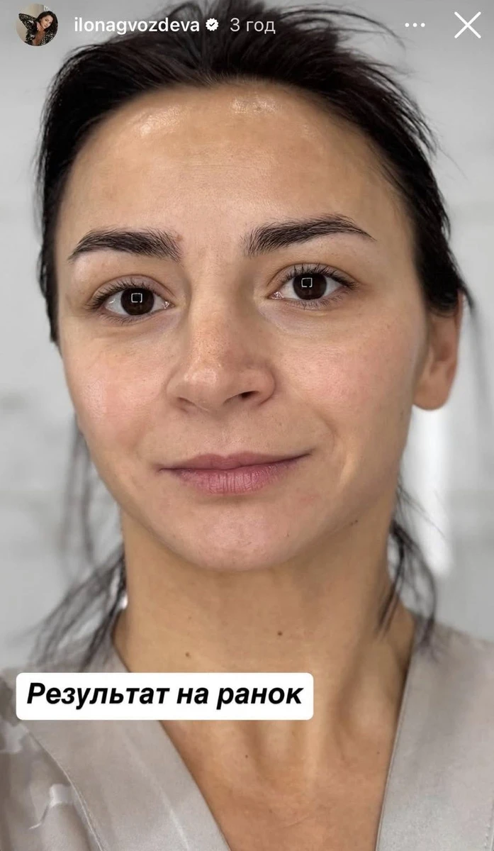 Результат після тейпів для обличчя