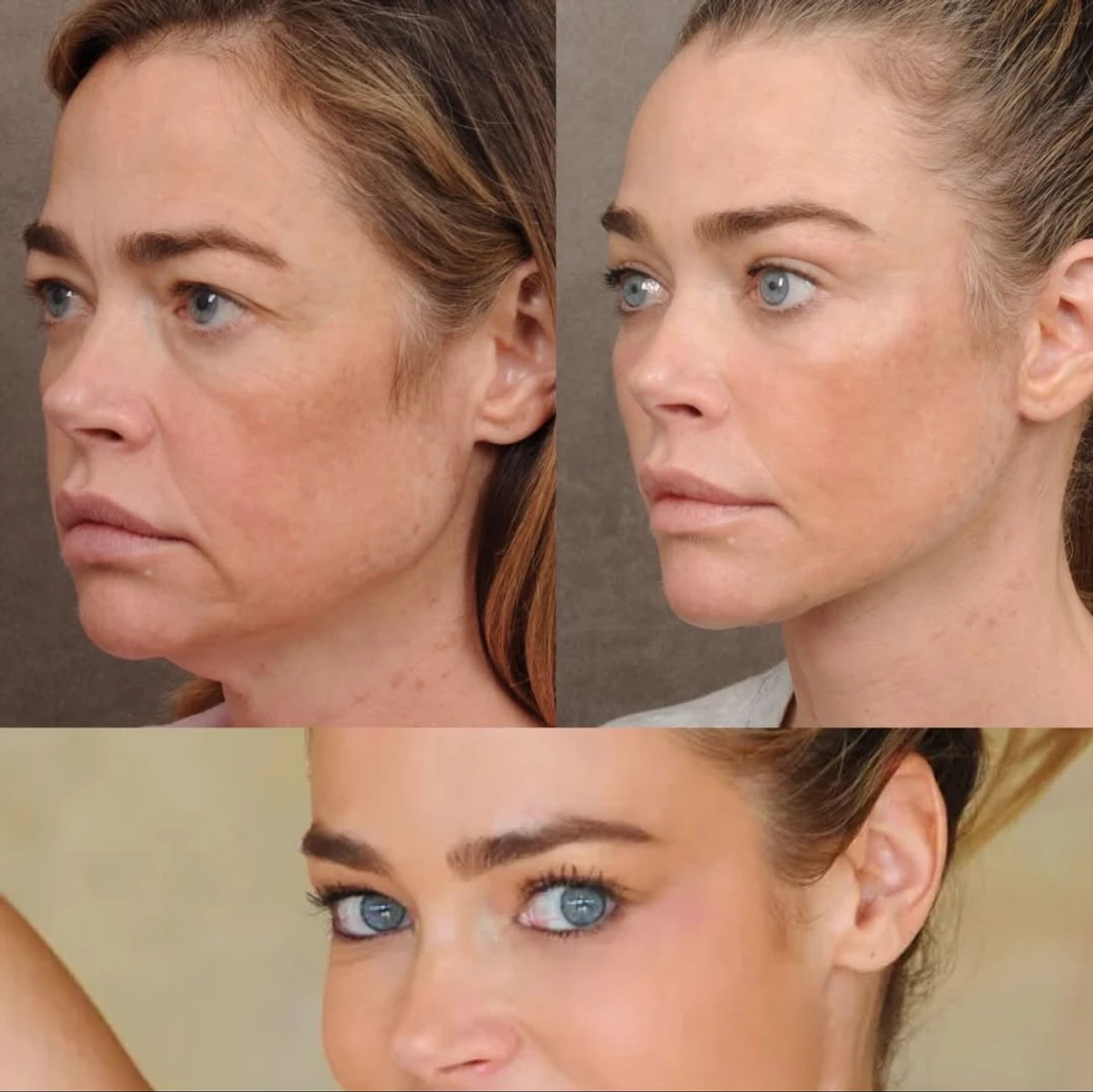 Деніз Річардс показалася після пластичної операції