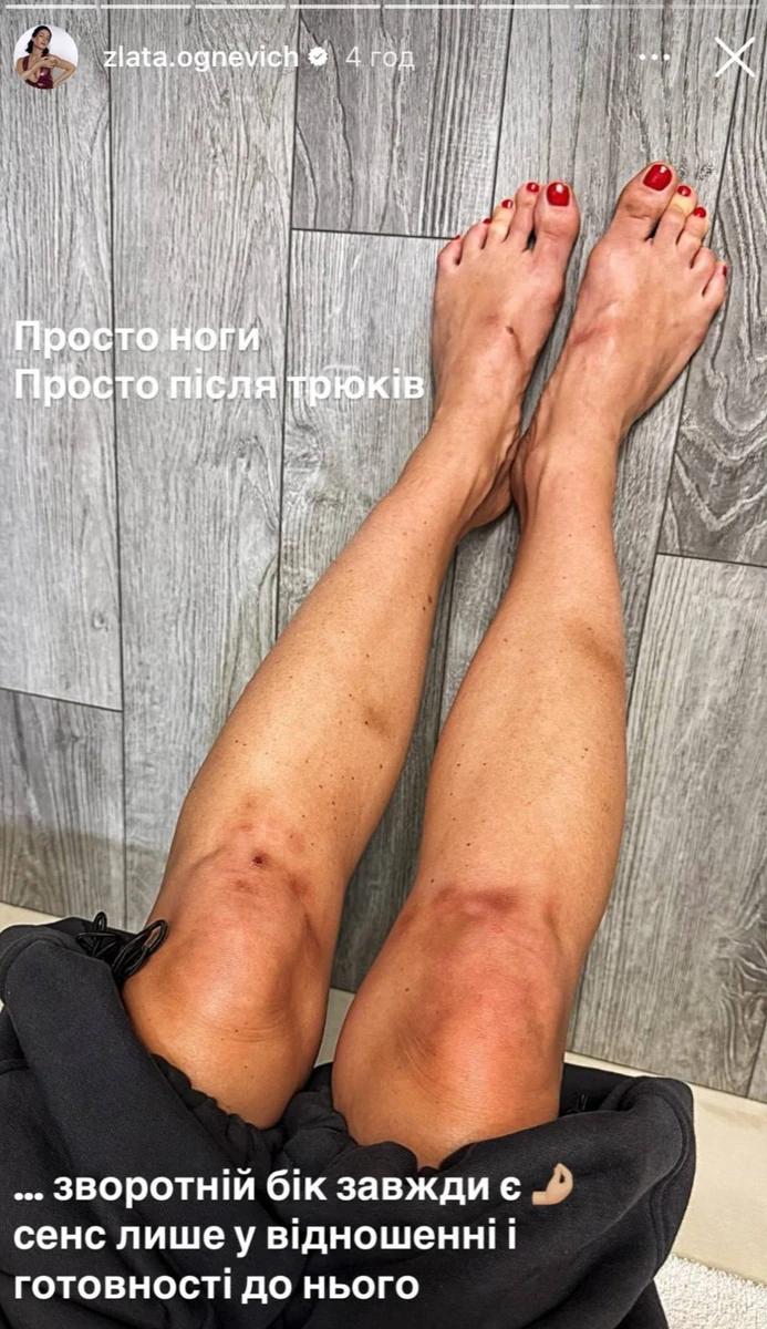 Злата Огнєвіч показала наслідки трюків