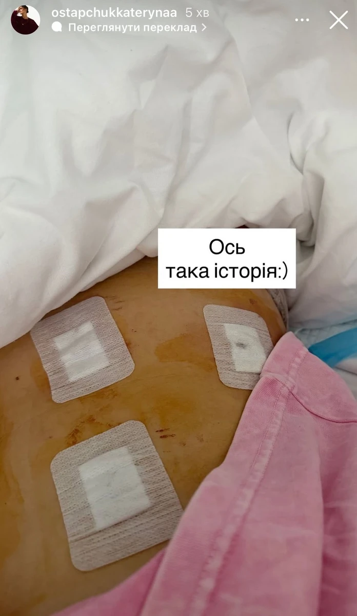Лапараскопічне видалення жовчного