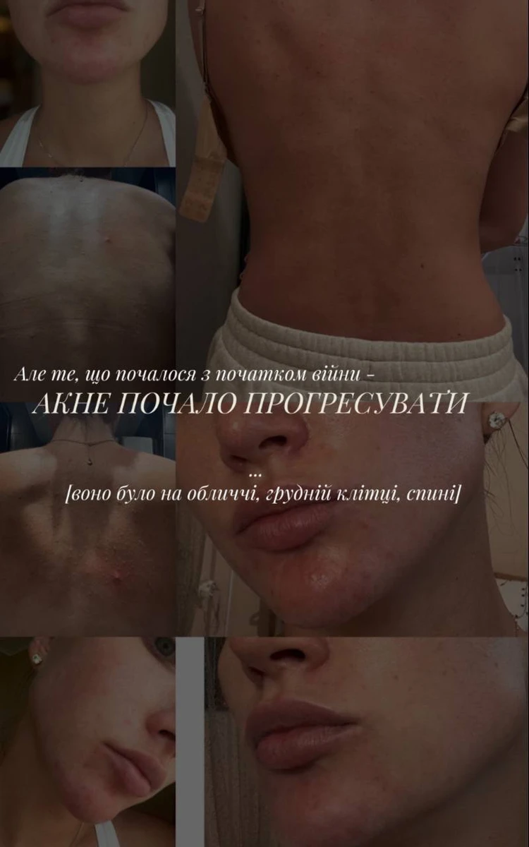 Висипи були не лише на обличчі