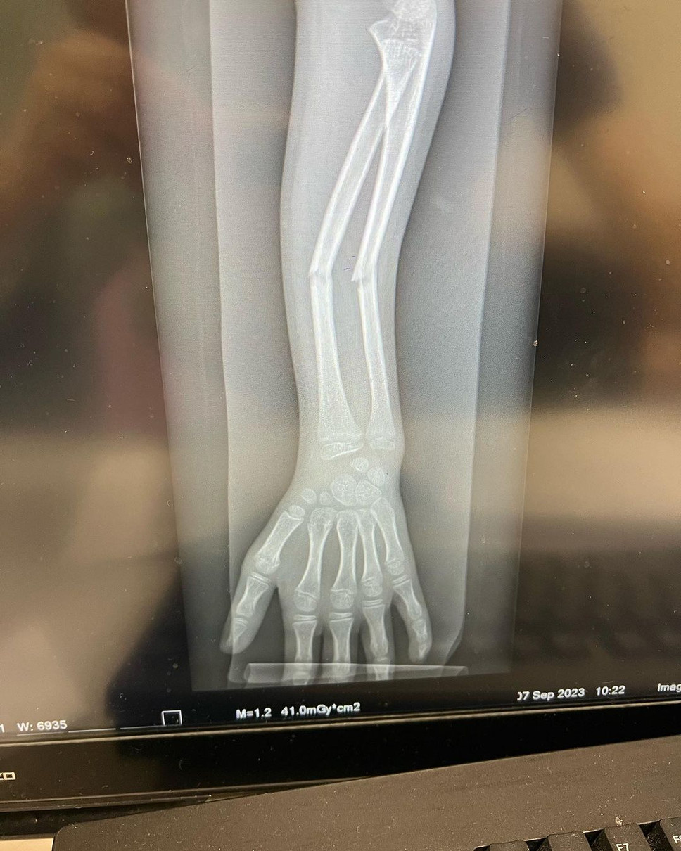 Рентгенівський знімок перелому дівчинки