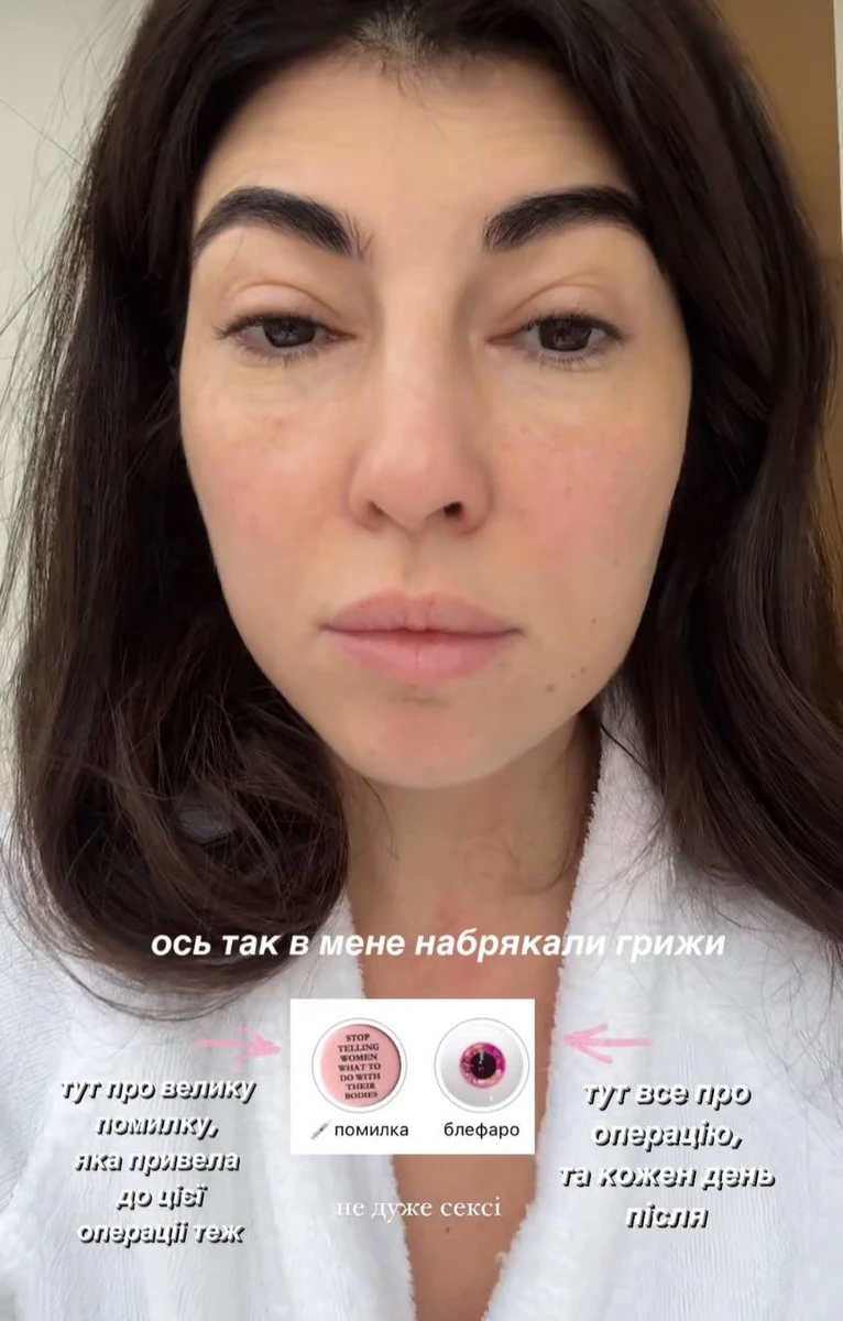 У лютому 2023-го через помилку косметолога обличчя Сабіни почало набрякати (адже разом зі зволоженням їй ввели полімолочну кислоту)