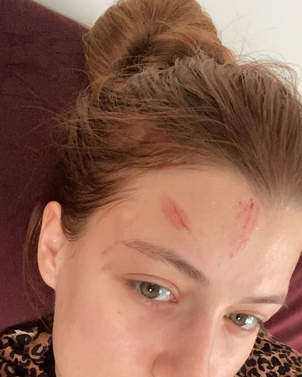 Сліди насильства на обличчі