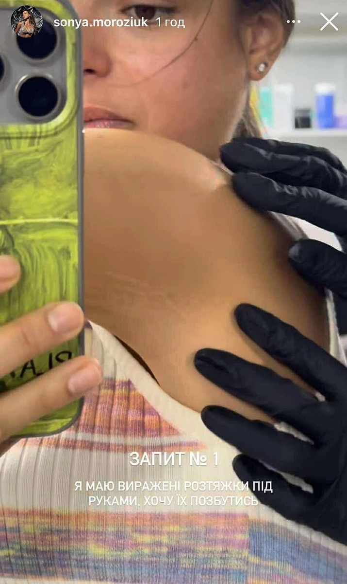 Соня показала свої розтяжки на руках 