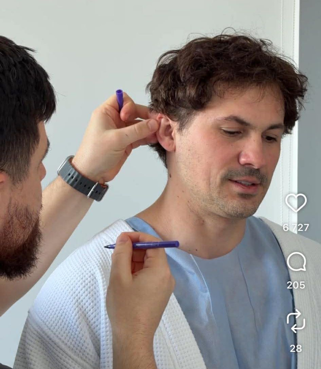 На відео лікар щось позначає на вухах так, як зазвичай роблять пластичні хірурги