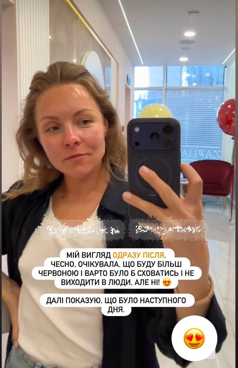Лікування розацеа