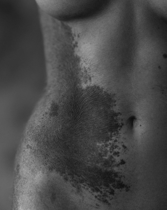 В інтерв'ю ТаблоID Юссеф розповідала, що ця родимка часто приносить їй дискомфорт, особливо під час стресу 