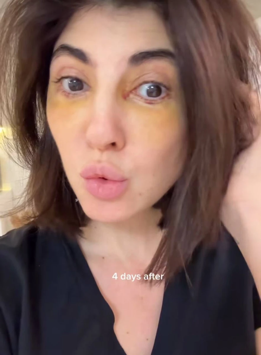 Вже за 4 дні синці майже спали