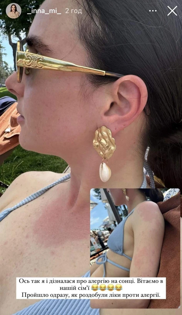 Інна Мірошниченко та її алергія на сонце