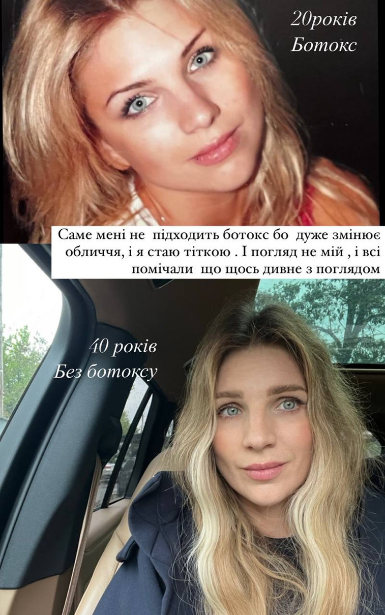 Вперше Сільченко вколола ботокс у 20 років, і вже тоді зрозуміла, що ця процедура псує вираз її обличчя