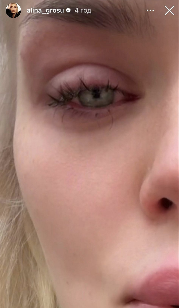 Стирання рогівки