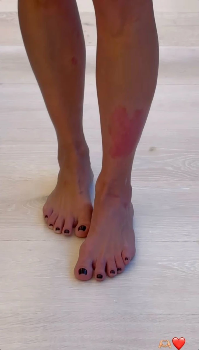 Кардашян заявила, що не знає, що спричинило загострення хвороби цього разу