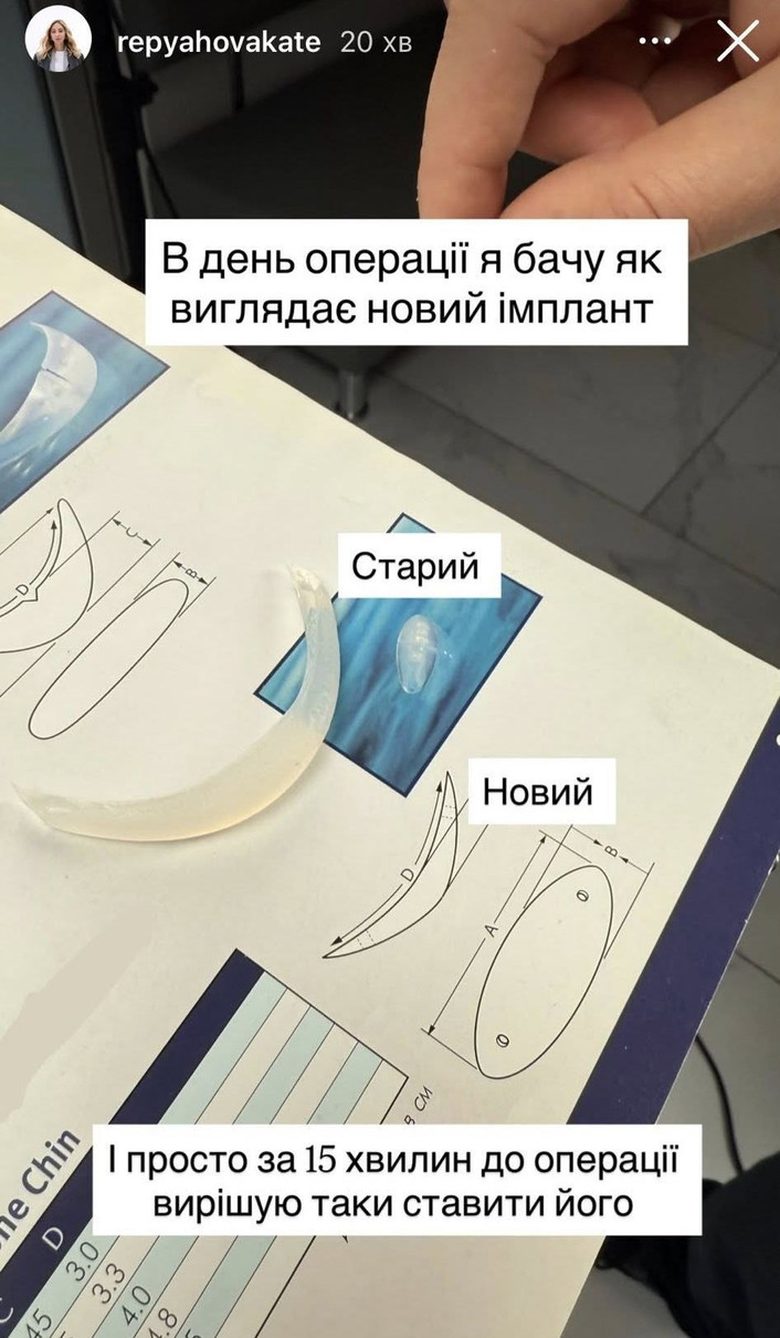 Дружина Павліка та імплант в підборіддя