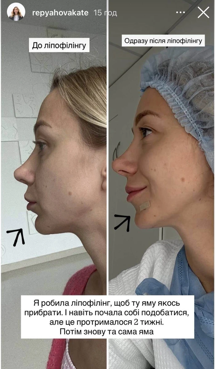 Ліпофілінг підборіддя Репяхової