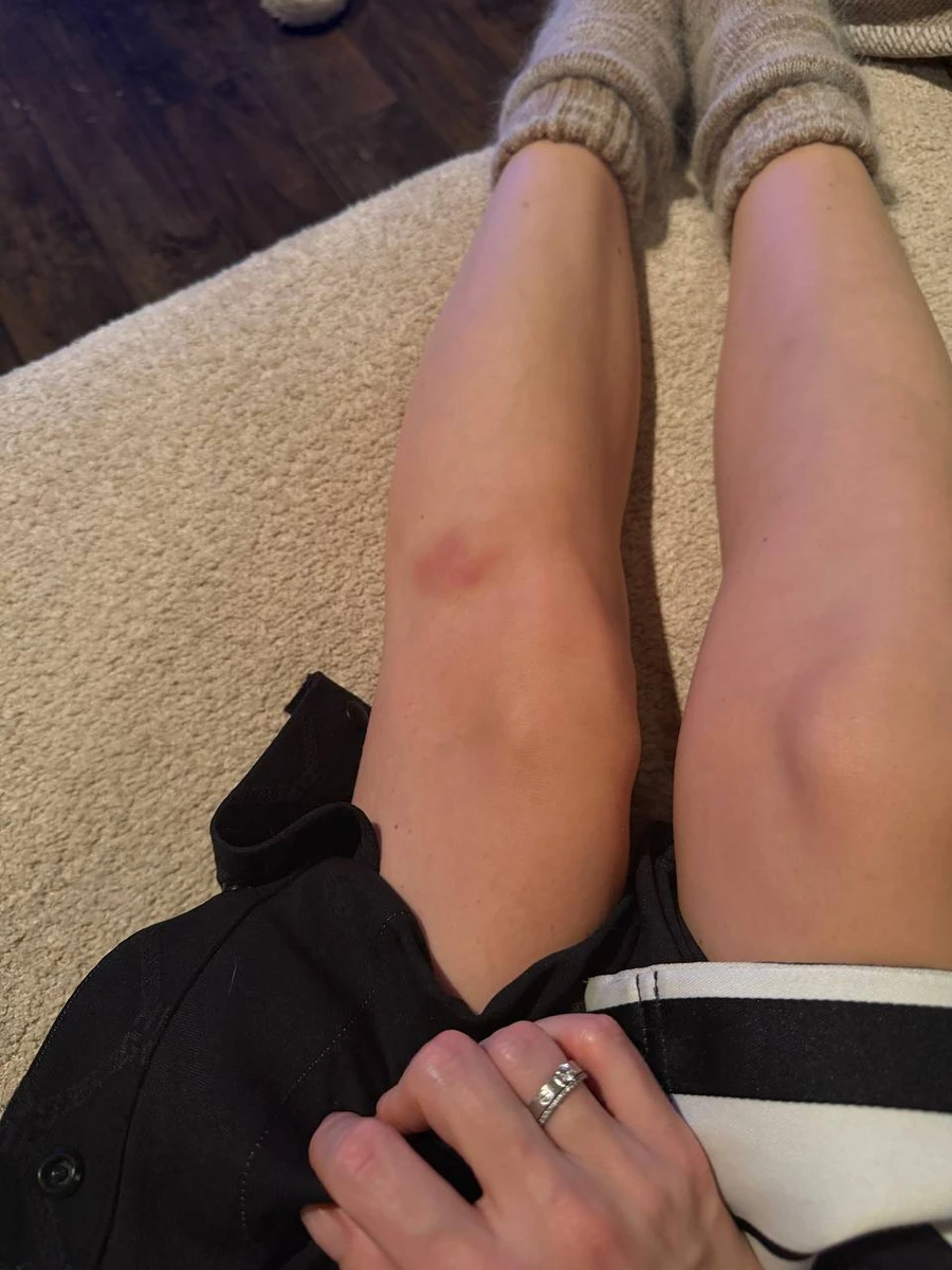 Надя Дорофєєва показала синці на тілі після танців