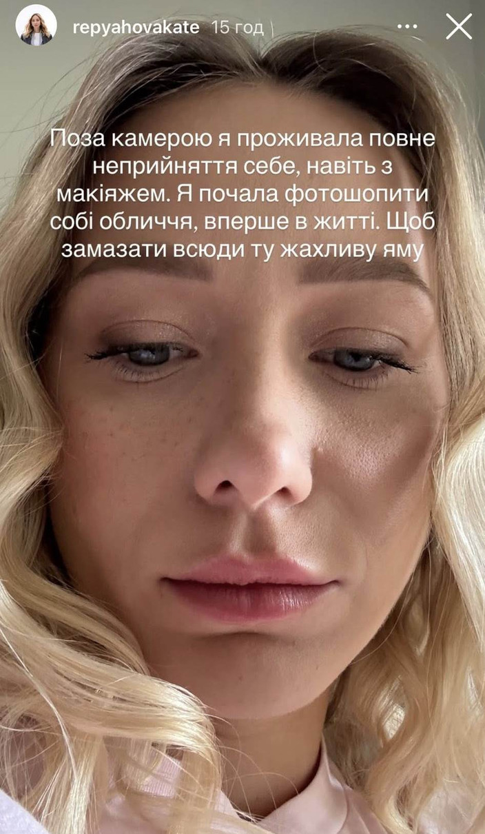 Катерина Репяхова і пластика підборіддя