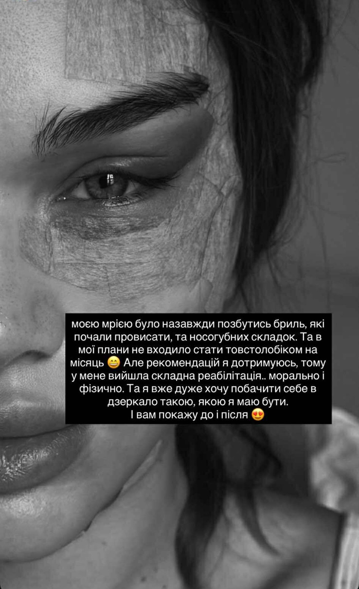 Саша Бо показала своє обличчя після підтяжки