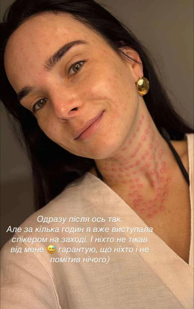 Мірошниченко показала, яку процедуру для шиї робить